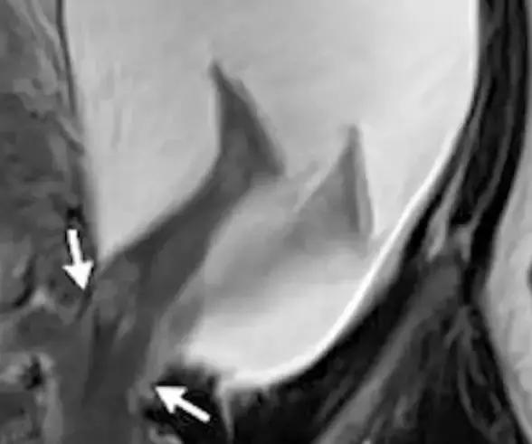 胎儿无影脚,胎儿恐怖成像