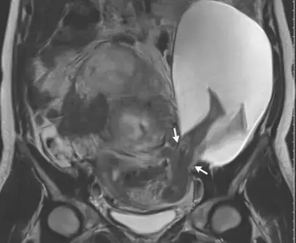 胎儿无影脚,胎儿恐怖成像