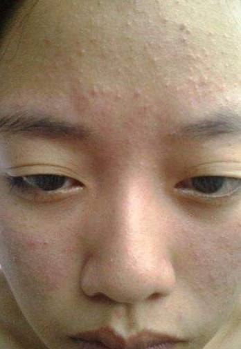 脸上长满了闭合性闭口粉刺怎么办,什么是闭口粉刺什么是痘痘