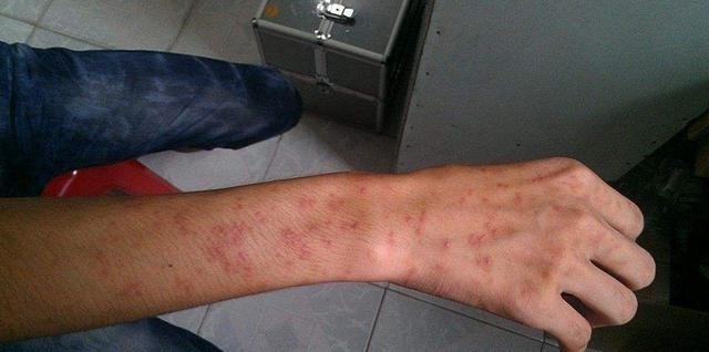 10年湿疹又痒又丑，老医师的一好方子，3周赶走烦人湿疹！