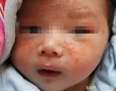 宝宝被湿疹折磨苦不堪言,是因为你没用对方法!
