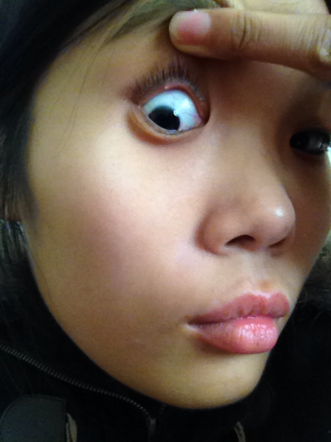 眼球凸出眼睛是变大还是变小,眼球正常是凸出来多少