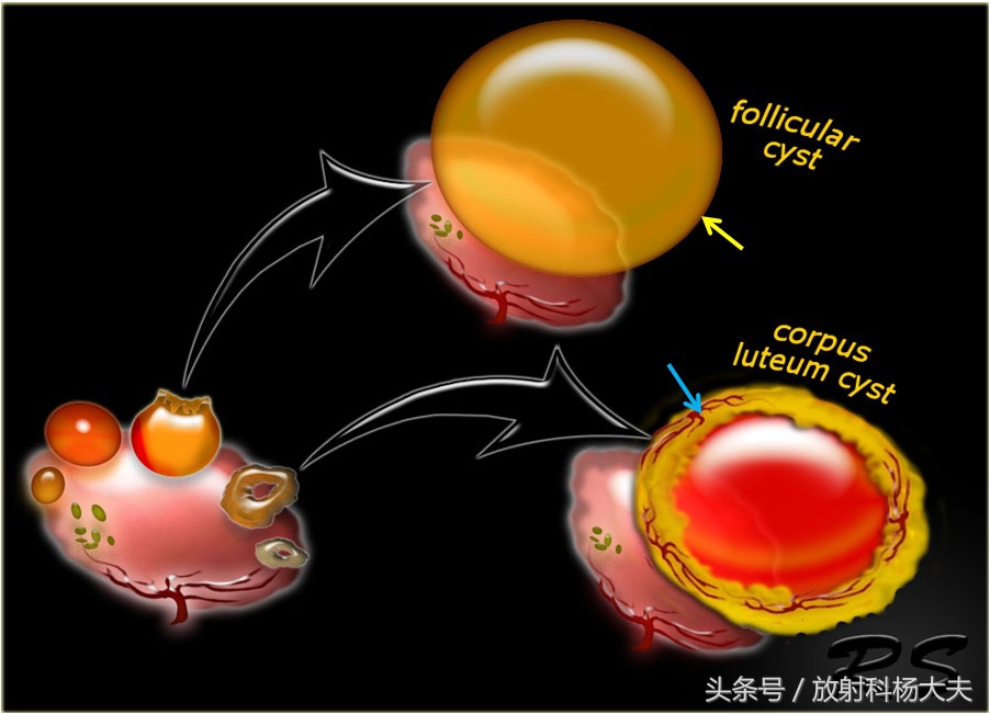核磁上这种卵巢囊肿的壁血供丰富，属于良性，需小心外力撞击破裂