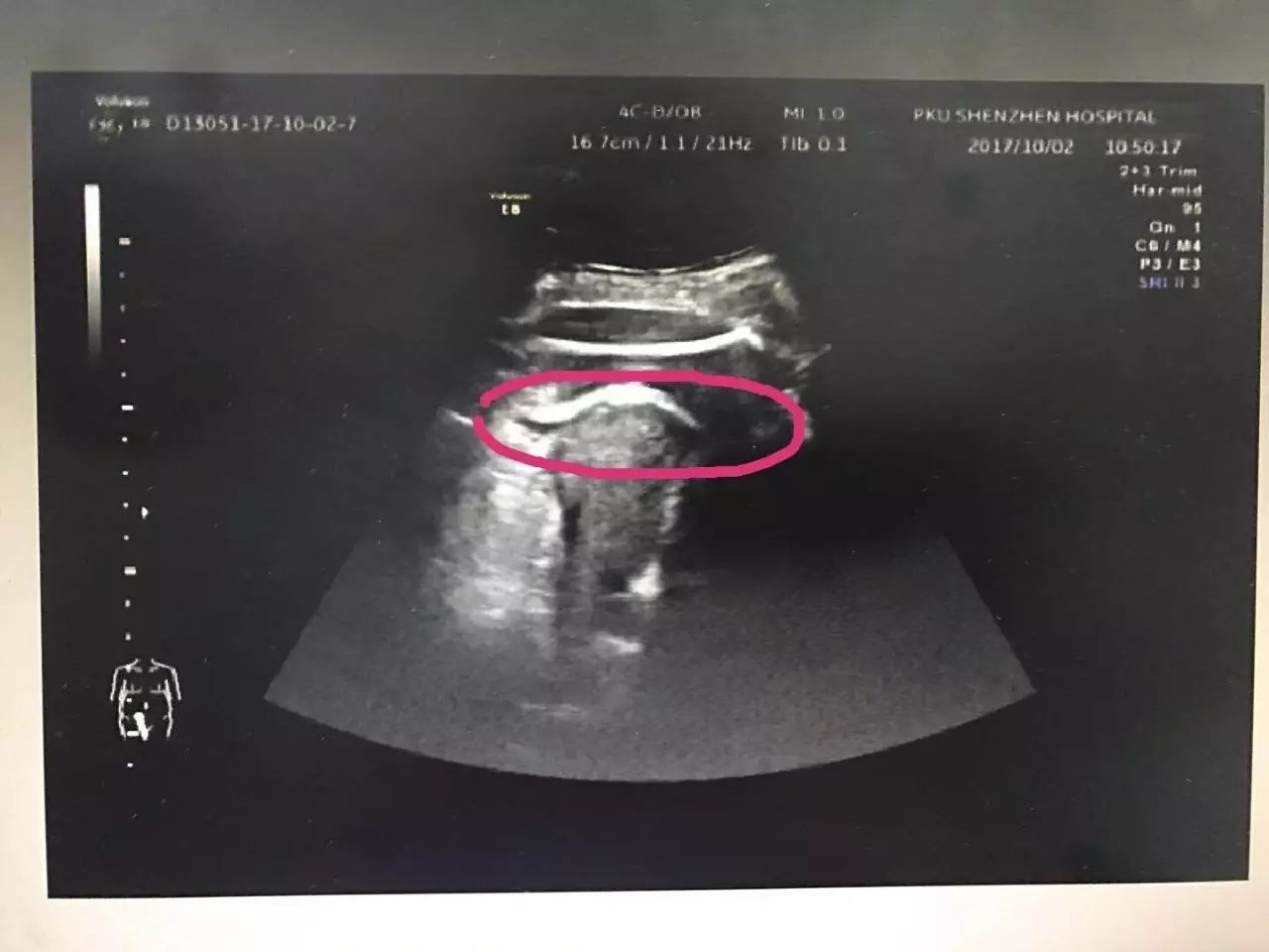 怀孕了宝宝踢肚子疼怎么办,怀孕八个月流产肚子被踢