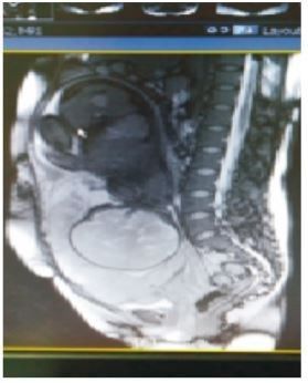 控制凶险性前置胎盘出血，止血带渐进式应用技术功不可没