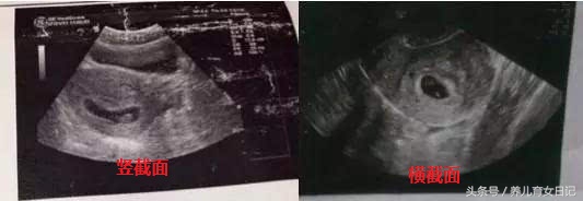 孕囊形状可以看出流产吗,孕囊可以判断胎儿的健康吗