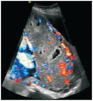 控制凶险性前置胎盘出血，止血带渐进式应用技术功不可没