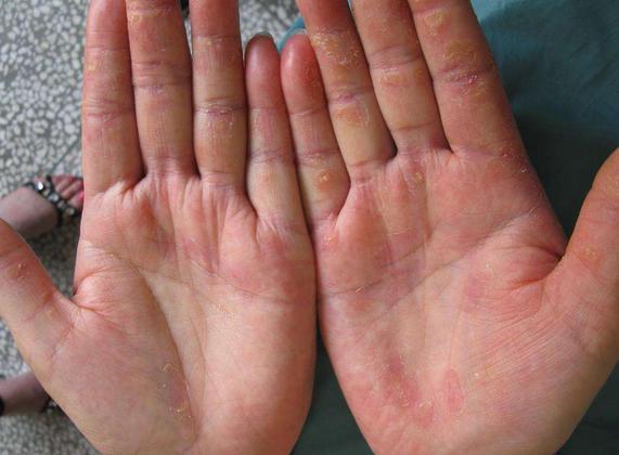 10年湿疹又痒又丑，老医师的一好方子，3周赶走烦人湿疹！