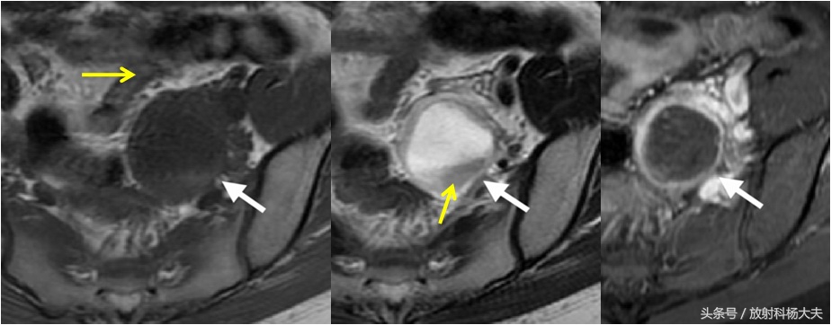 核磁上这种卵巢囊肿的壁血供丰富，属于良性，需小心外力撞击破裂