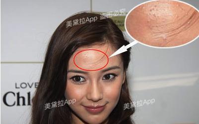 痘痘粉刺怎么根治,粉刺没有处理好变成硬疙瘩