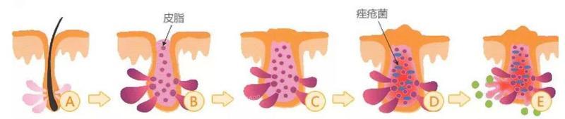 痘痘粉刺怎么根治,粉刺没有处理好变成硬疙瘩