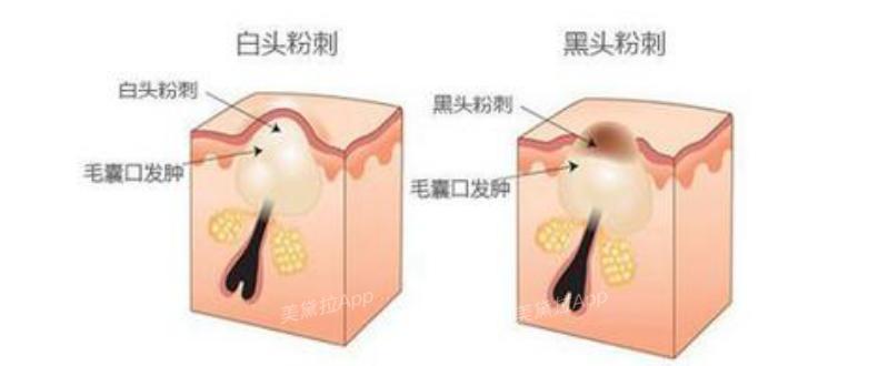 痘痘粉刺怎么根治,粉刺没有处理好变成硬疙瘩