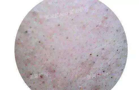 痘痘粉刺怎么根治,粉刺没有处理好变成硬疙瘩