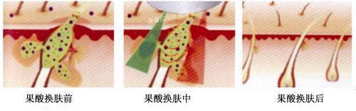 痘痘粉刺怎么根治,粉刺没有处理好变成硬疙瘩