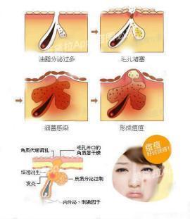 痘痘粉刺怎么根治,粉刺没有处理好变成硬疙瘩
