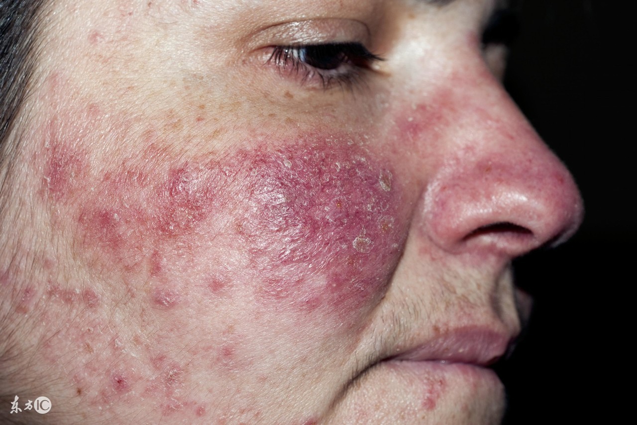 治疗激素脸真的像修仙一样！除了忌口，激素脸治疗还有哪些注意的