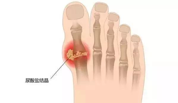 又一吃出来的大病！“三高”之外的“第四高”，让1.7亿人深受困