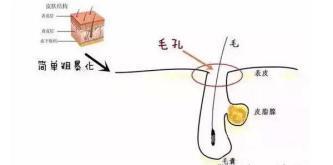痘痘粉刺怎么根治,粉刺没有处理好变成硬疙瘩