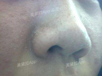 痘痘粉刺怎么根治,粉刺没有处理好变成硬疙瘩