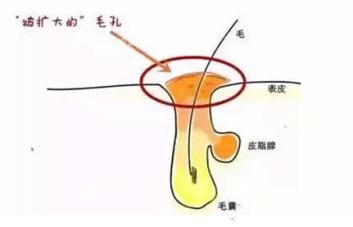 痘痘粉刺怎么根治,粉刺没有处理好变成硬疙瘩