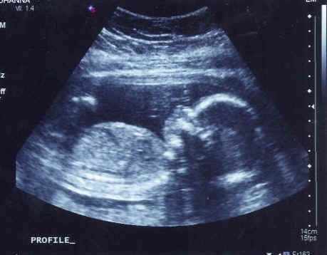 b超查卵泡用憋尿吗？卵泡检查需要憋尿吗？监测卵泡需要空腹吗？