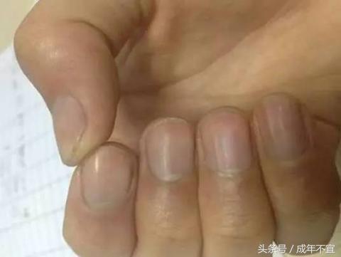 手指半月牙正常图片,手指没有半月牙是怎么回事