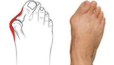 骨科矫正脚趾的正确方法,骨科医生治脚疼视频