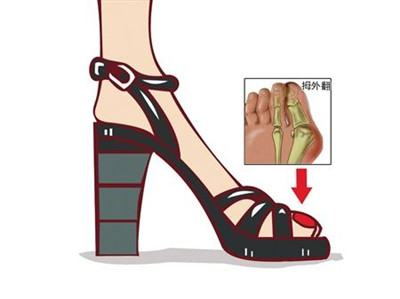 骨科矫正脚趾的正确方法,骨科医生治脚疼视频