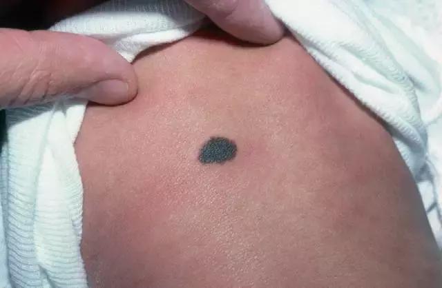 胎记及早治疗,胎记不治有什么后果