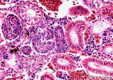 iga肾病要怎么治疗才能痊愈,iga肾病如何引起