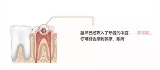 同样是补牙价格为什么差很远,同样补牙为什么报销不一样