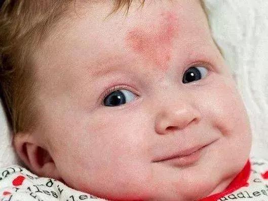 胎记及早治疗,胎记不治有什么后果