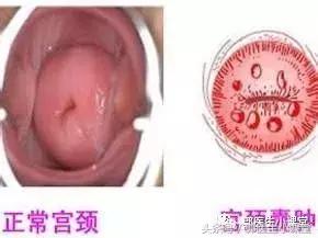 宫颈纳氏囊肿，一个不需要治疗的病