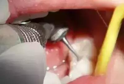 同样是补牙价格为什么差很远,同样补牙为什么报销不一样