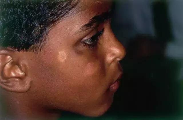 胎记及早治疗,胎记不治有什么后果