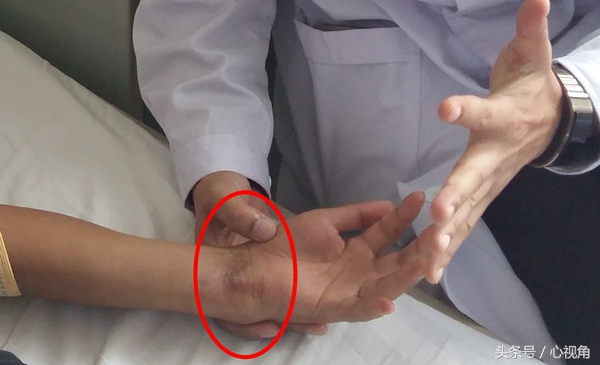 骨折后自行包中草药治疗，3个月后左腕部出现畸形