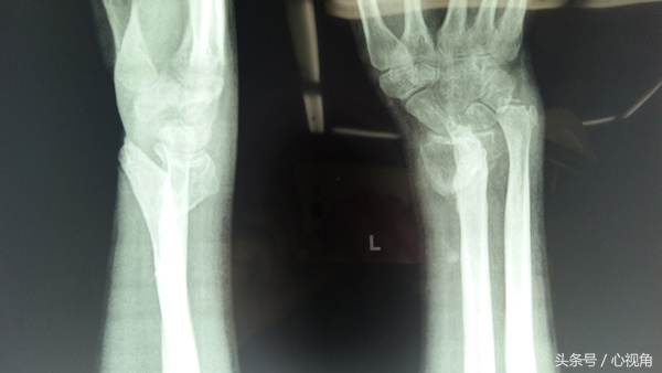 骨折后自行包中草药治疗，3个月后左腕部出现畸形