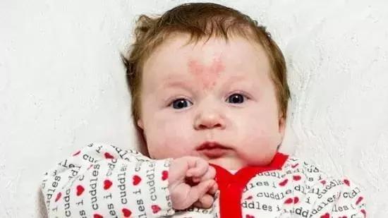 胎记及早治疗,胎记不治有什么后果