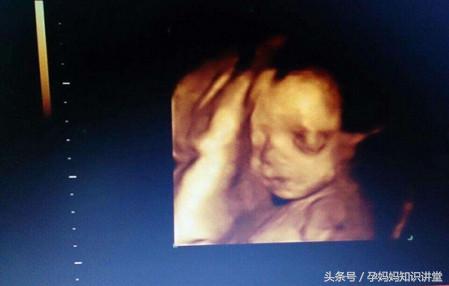 拍四维彩超让注意左肾情况,做四维彩超需要注意什么