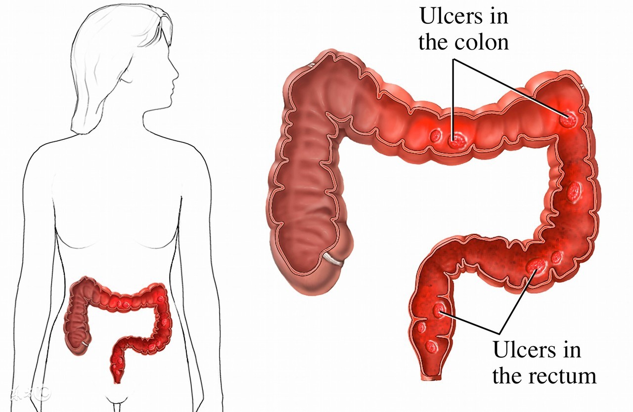 肠梗阻老年病人不再呕吐,老年患者肠梗阻护理措施