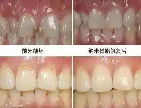 同样是补牙价格为什么差很远,同样补牙为什么报销不一样