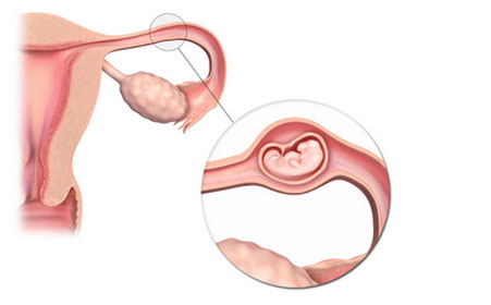 宫外孕会来月经没,宫外孕会来月经吗有什么症状