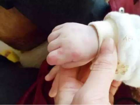 幼儿手上长红点,幼儿手上有红点是怎么回事