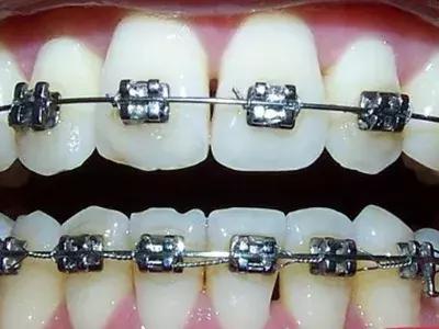 戴牙套托槽松动怎么办,牙套托槽丢了补一个多少钱