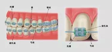 戴牙套托槽松动怎么办,牙套托槽丢了补一个多少钱