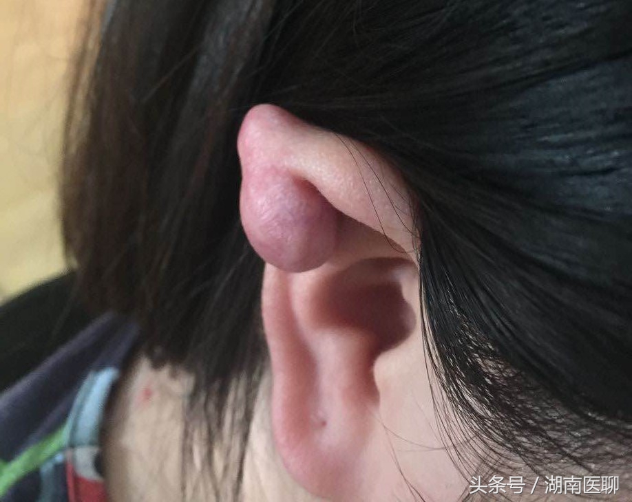 女子打耳洞长出肉瘤,打耳洞后长出蚕豆大小的肉疙瘩