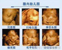 做四维彩超有什么注意事项,做四维彩超的注意事项是什么