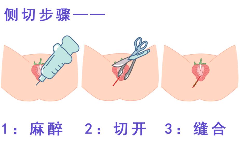 顺产时怎么避免侧切和撕裂,顺产最怕遇到的侧切该如何避免