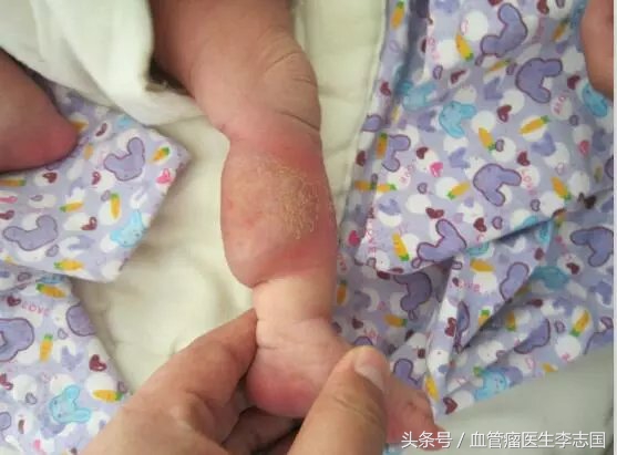 儿童医院做血管瘤激光治疗视频,婴幼儿血管瘤打激光几次能打掉