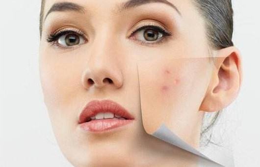 如何祛痘印最有效简单方法,怎么祛痘印最快最有效的方法